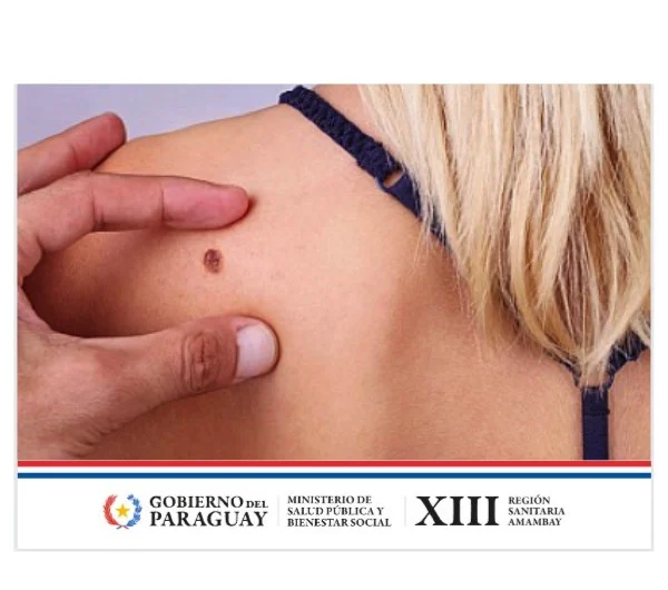 Salud: Cuidado de la piel en verano: protección y prevención crucial
